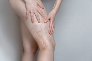 Woman shows leg with varicose veins